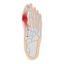 Überbein-Schutz, 2 Paar